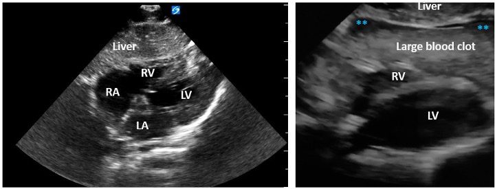Ultrasound subcostal view