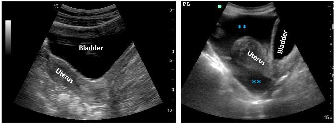 Ultrasound mid-saggital view