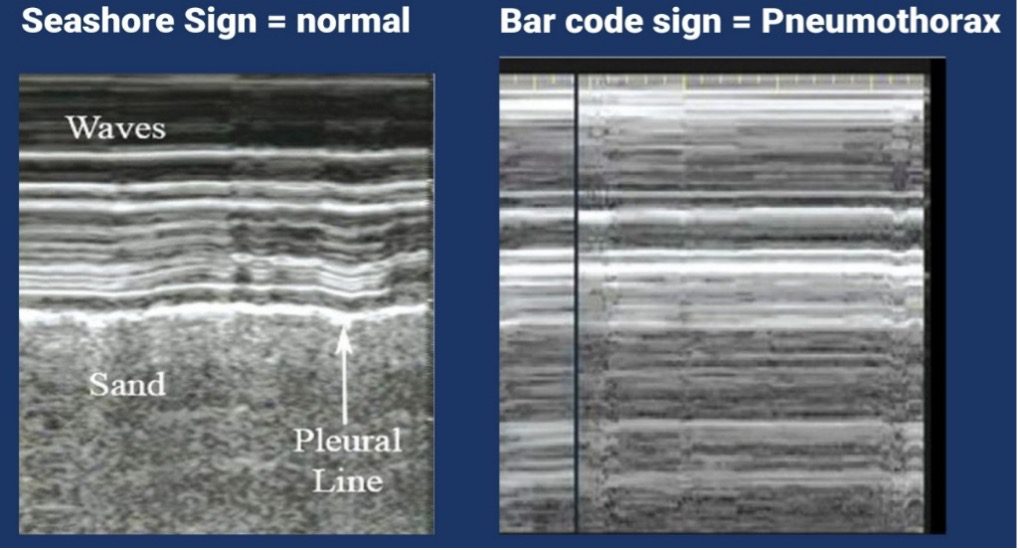 Ultrasound seashore vs barcode sign
