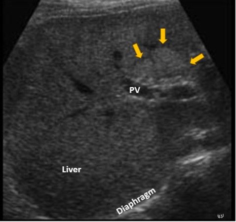 View of focal fatty liver