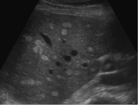 View of focal fatty liver lesions