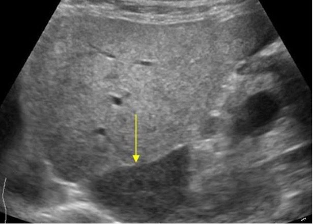 View of fatty liver with non-fatty changes