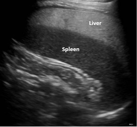 View of enlarged fatty liver