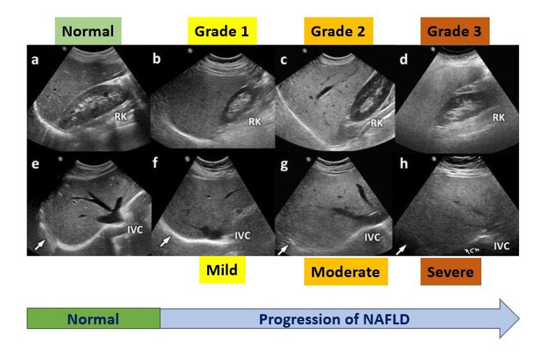 View of progression of NAFLD