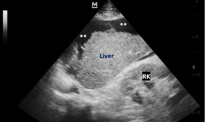 View of advanced stage NAFLD