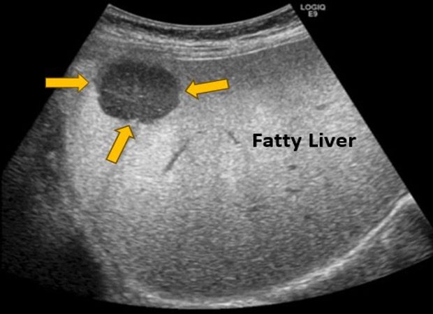 View of moderate fatty liver