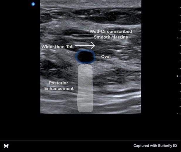 Labeled ultrasound view of benign breast lump