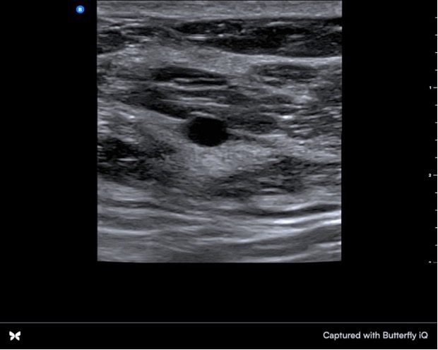 Ultrasound view of benign breast lump