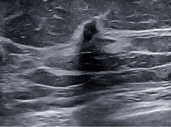 View of benign breast ultrasound