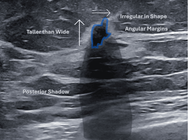 Labeled view of benign breast ultrasound