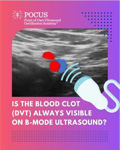 DVT clot blog graphic