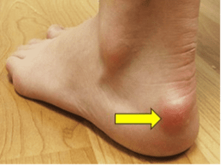 Photo of Haglund's deformity on patient's heal