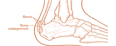 Detailed sketch of Haglund's deformity