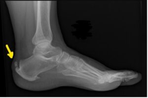 Xray image of Haglund's deformity