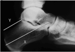Xray image of Haglund's deformity overlaid with calcaneus measurments
