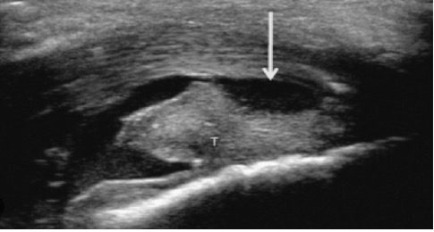 Ultrasound image of achilles bursitis