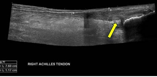 Ultrasound view of achilles tendon swelling