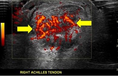 Doppler ultrasound view of achilles hyperemia