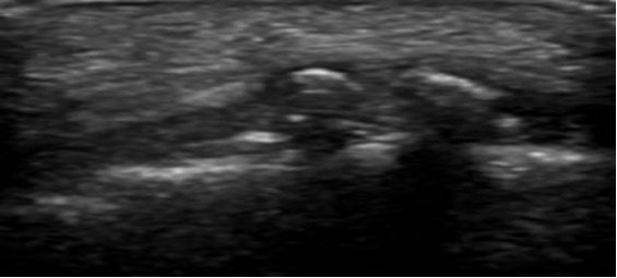 Ultrasound view of retrocalcaneal bursitis