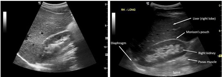 Longitudinal ultrasound view of health right kidney