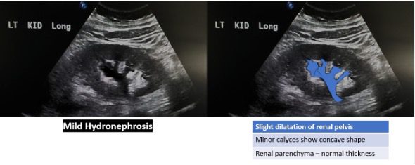 Ultrasound view of mild hydronephrosis
