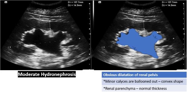 Ultrasound view of moderate hydronephrosis