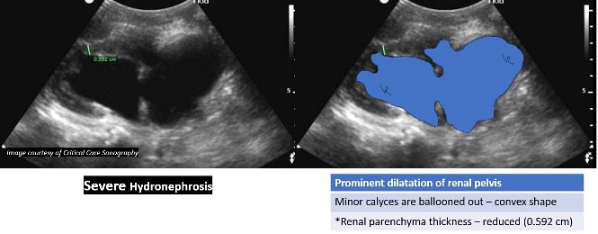 Ultrasound view of severe hydronephrosis
