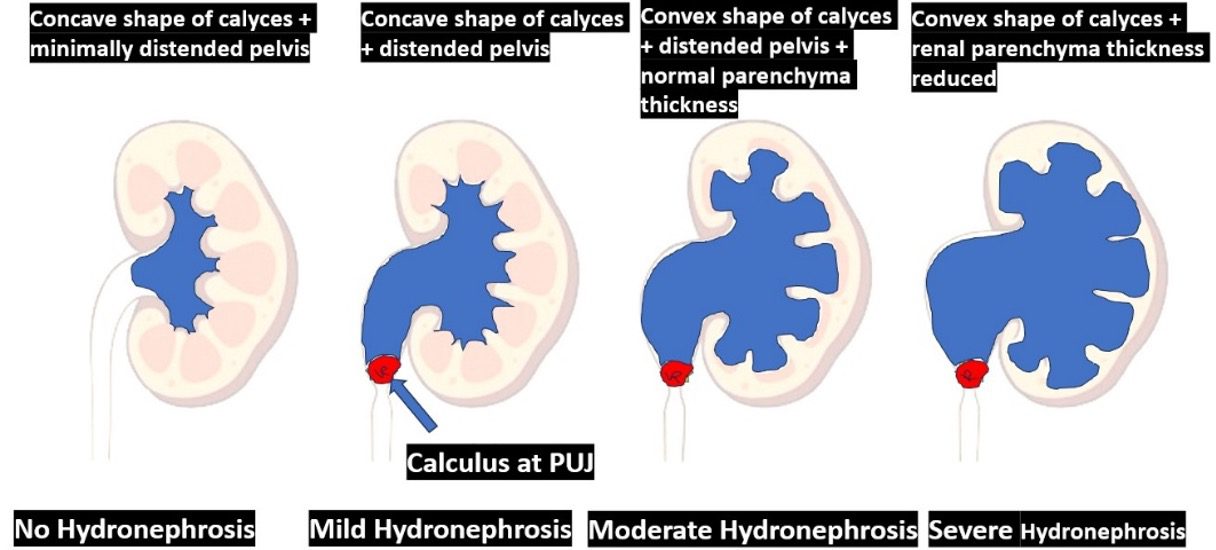 Diagrammatic representation of hydronephrosis grades