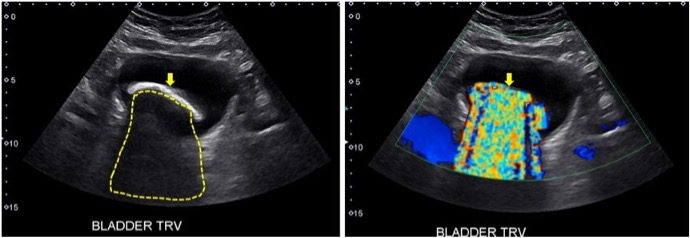 Ultrasound view of Twinkling artifact