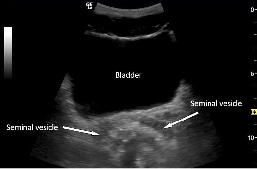 Transverse ultrasound view of bladder