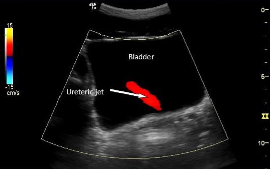 Ultrasound view of ureteric jet