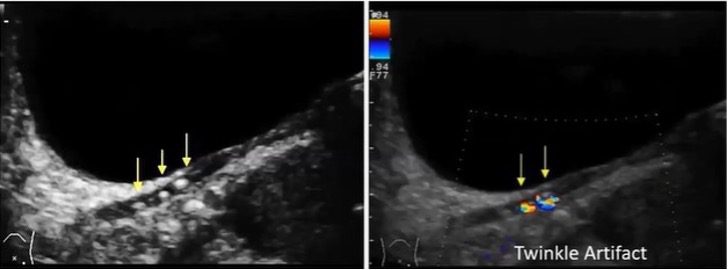 Ultrasound view of single hyperechoic calculus