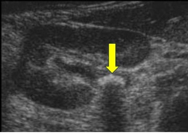 Transverse ultrasound view of kidney