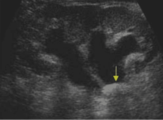 Longitudinal ultrasound view of kidney