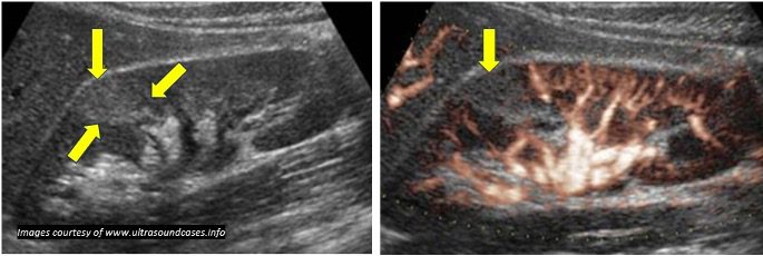 B-mode ultrasound view of suspicious lesion