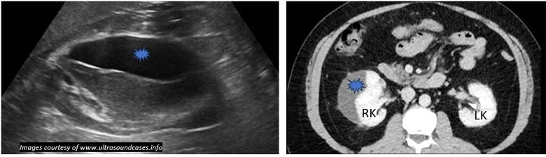 Ultrasound view of a urinoma