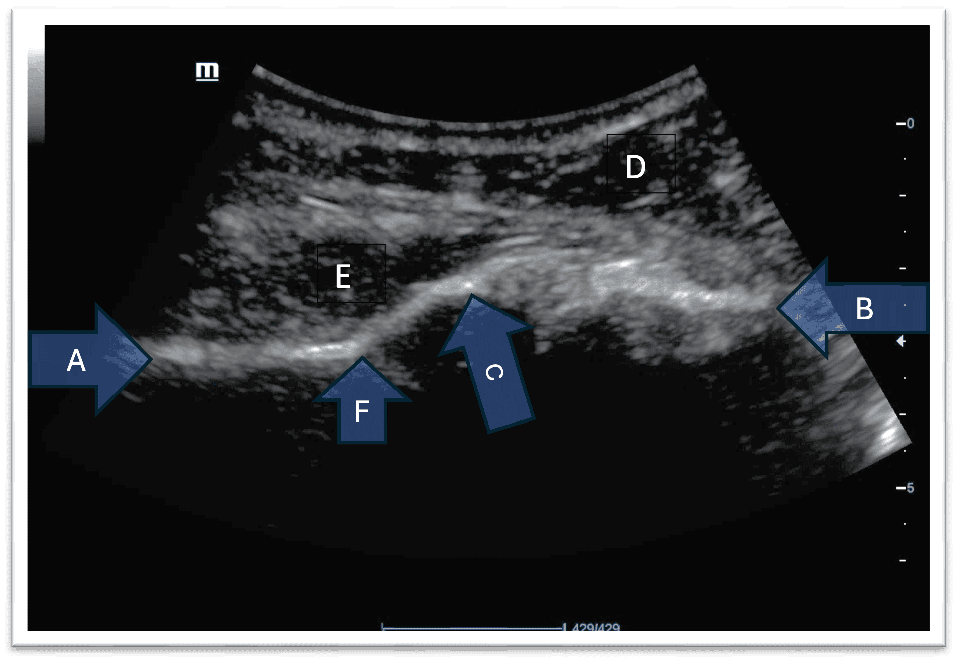 Labeled ultrasound image of shoulder joint