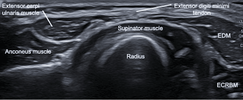 Ultrasound image of lateral elbow in distal transverse view
