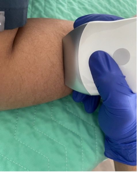 Image of patient arm with ultrasound probe in proper positioning