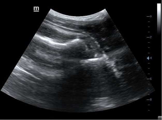 Ultrasound image of dislocated shoulder joint