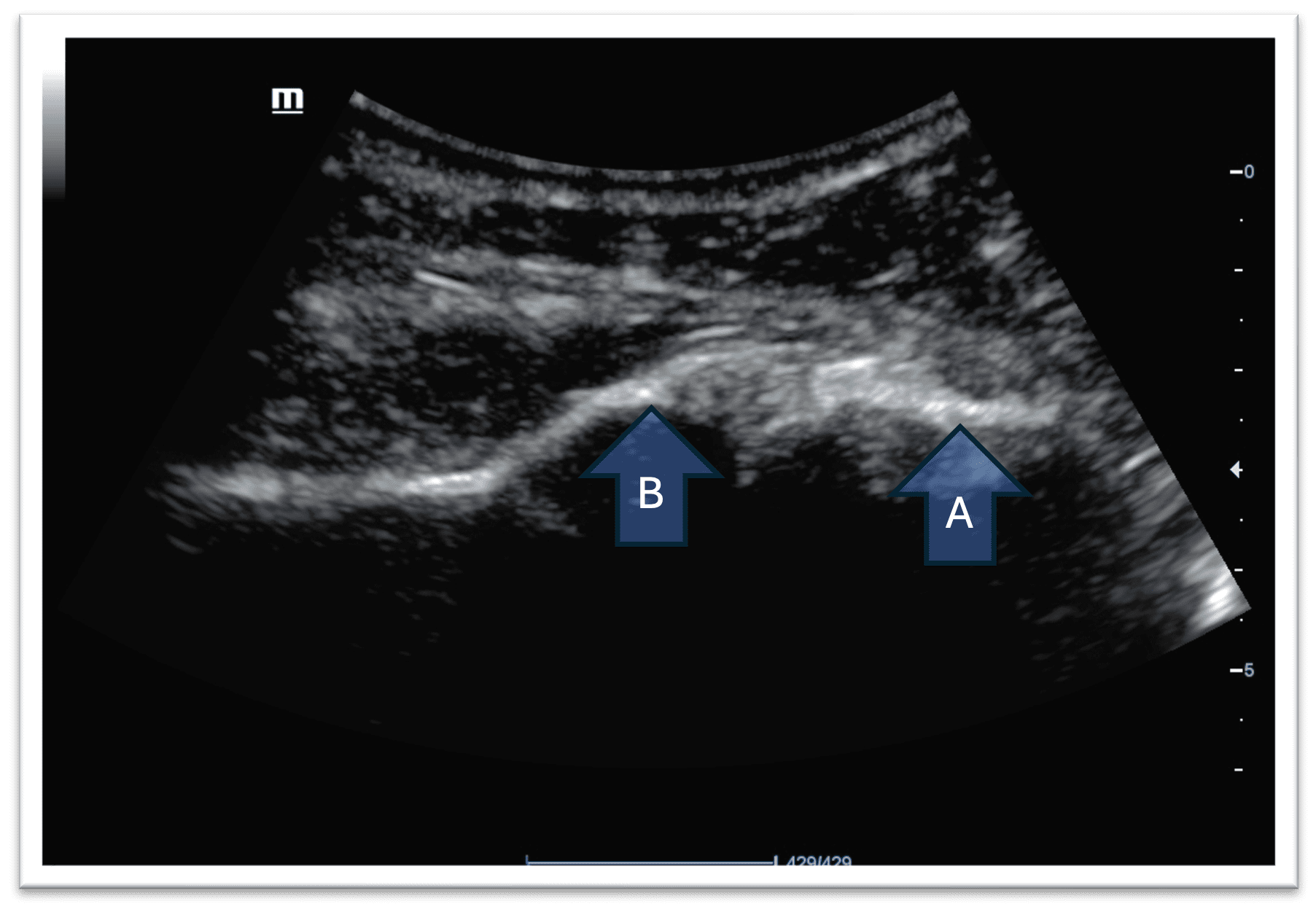 Labeled ultrasound image of normal shoulder joint and head of humerus