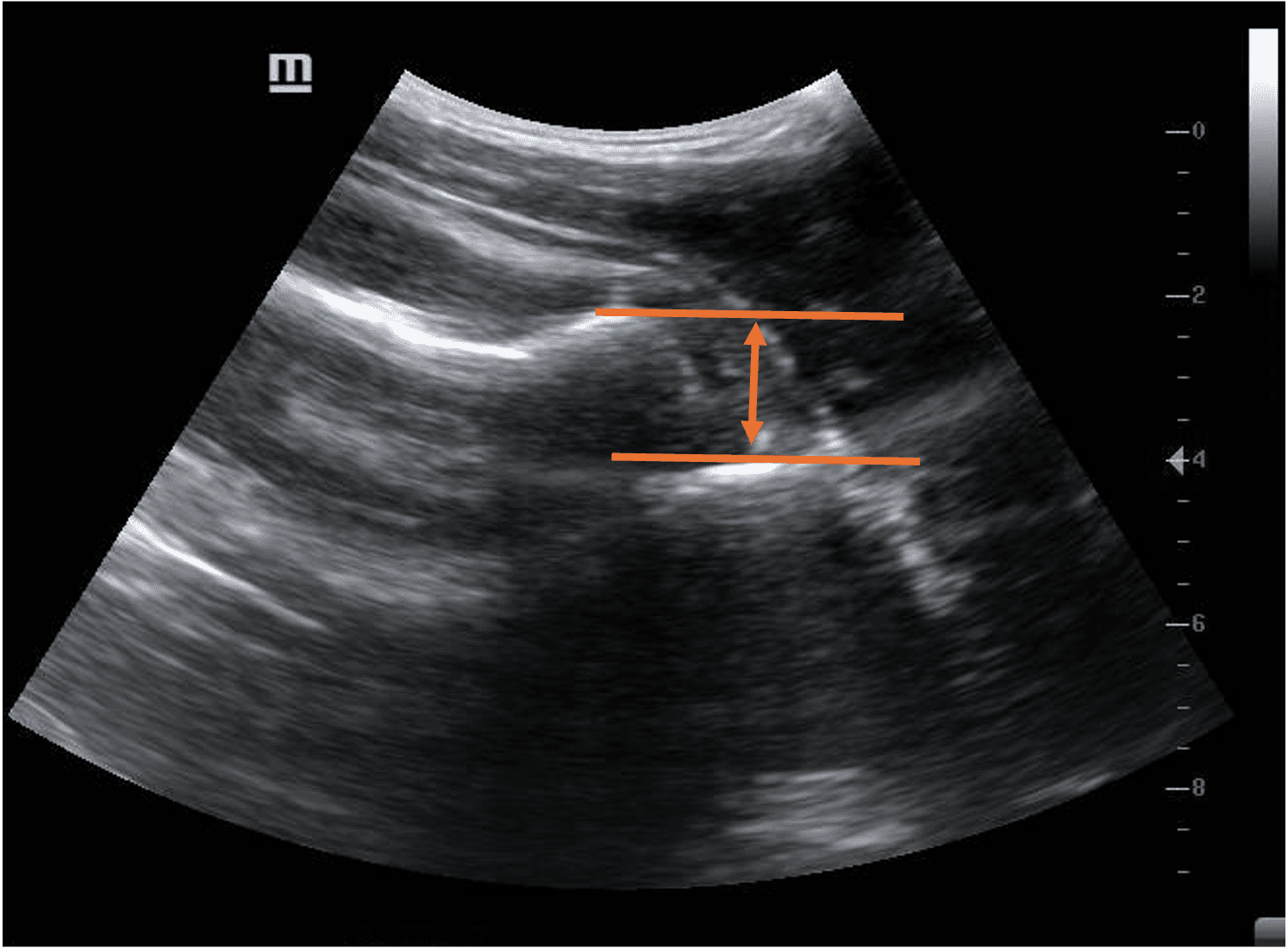 Labeled ultrasound image of dislocated shoulder joint