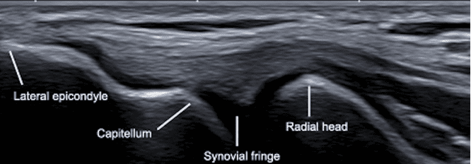 Ultrasound image of lateral elbow in longitudinal view