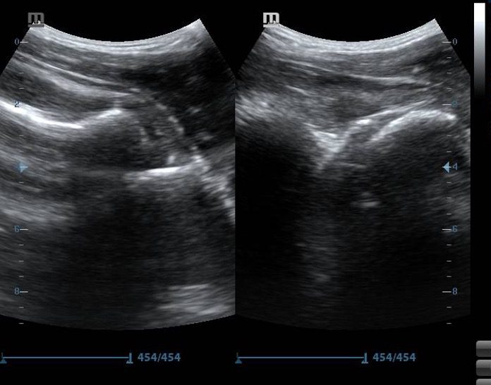 Side by side ultrasound image of should joint pre-reduction and post-reduction