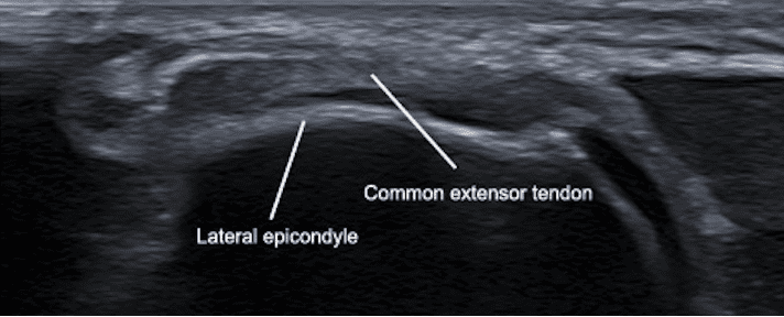 Ultrasound image of lateral elbow in transverse view