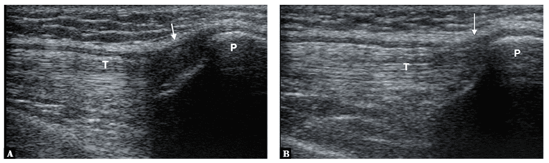 Ultrasound image of the quadriceps femoris tendon showing anisotropy artifact