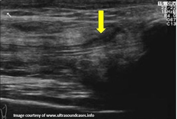 B-mode image showing superficial qadriceps tendon rupture