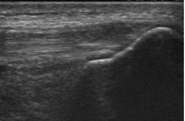 B-mode image showing quadriceps tendon tendonopathy