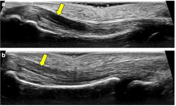 Ultrasound image of third finger flexor tendon showing anisotropy artifact