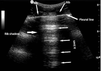 Ultrasound image of normal lung with A lines